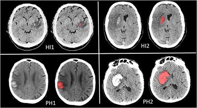 Frontiers Added Prognostic Value Of Hemorrhagic Transformation